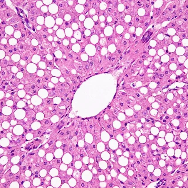 Textbook illustration of fatty liver tissue under a microscope