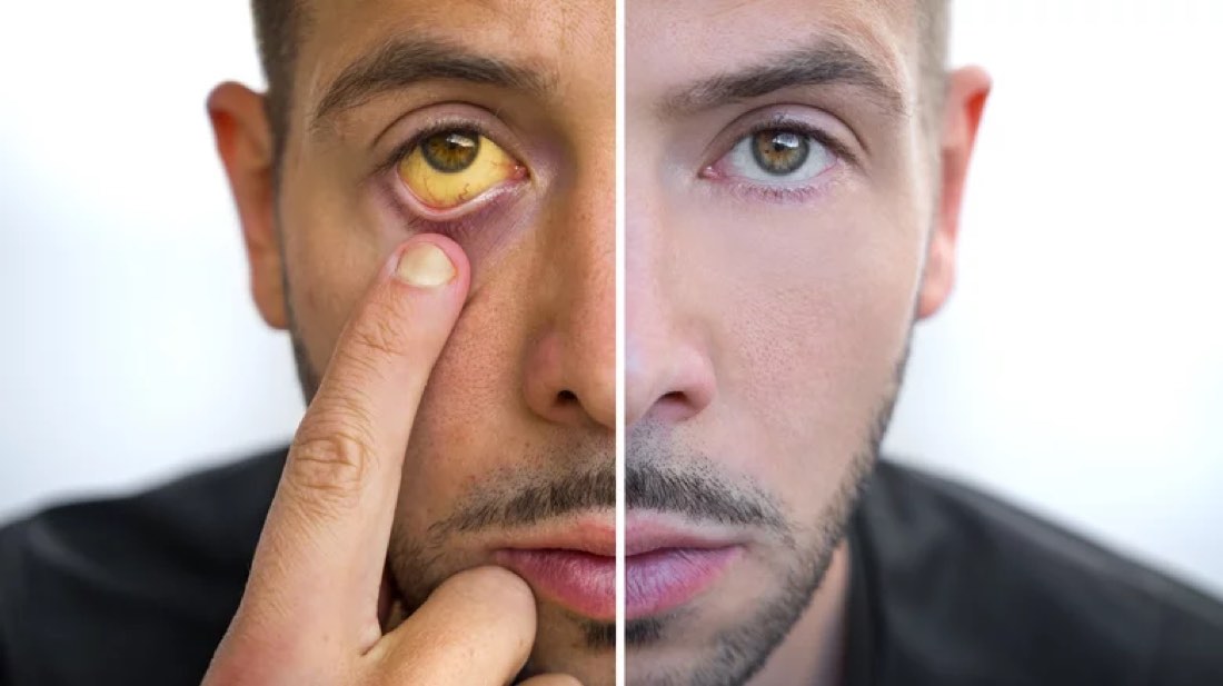 Before and after: jaundiced eye vs healthy eye