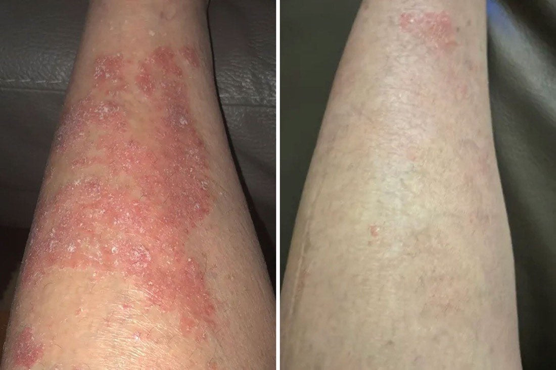Skin improvement comparison